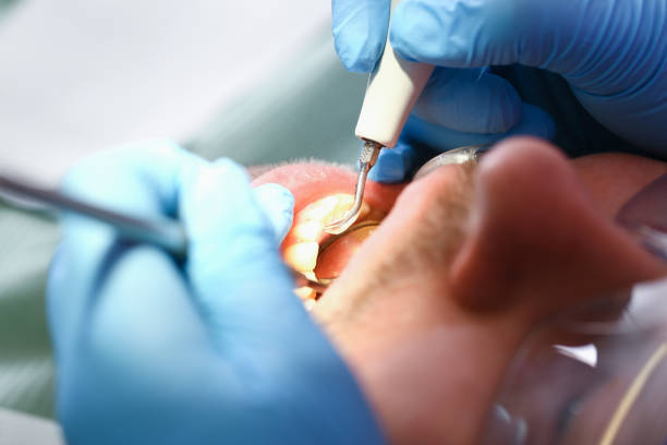Best Root Canal Emergency Dentist  in University City, MO